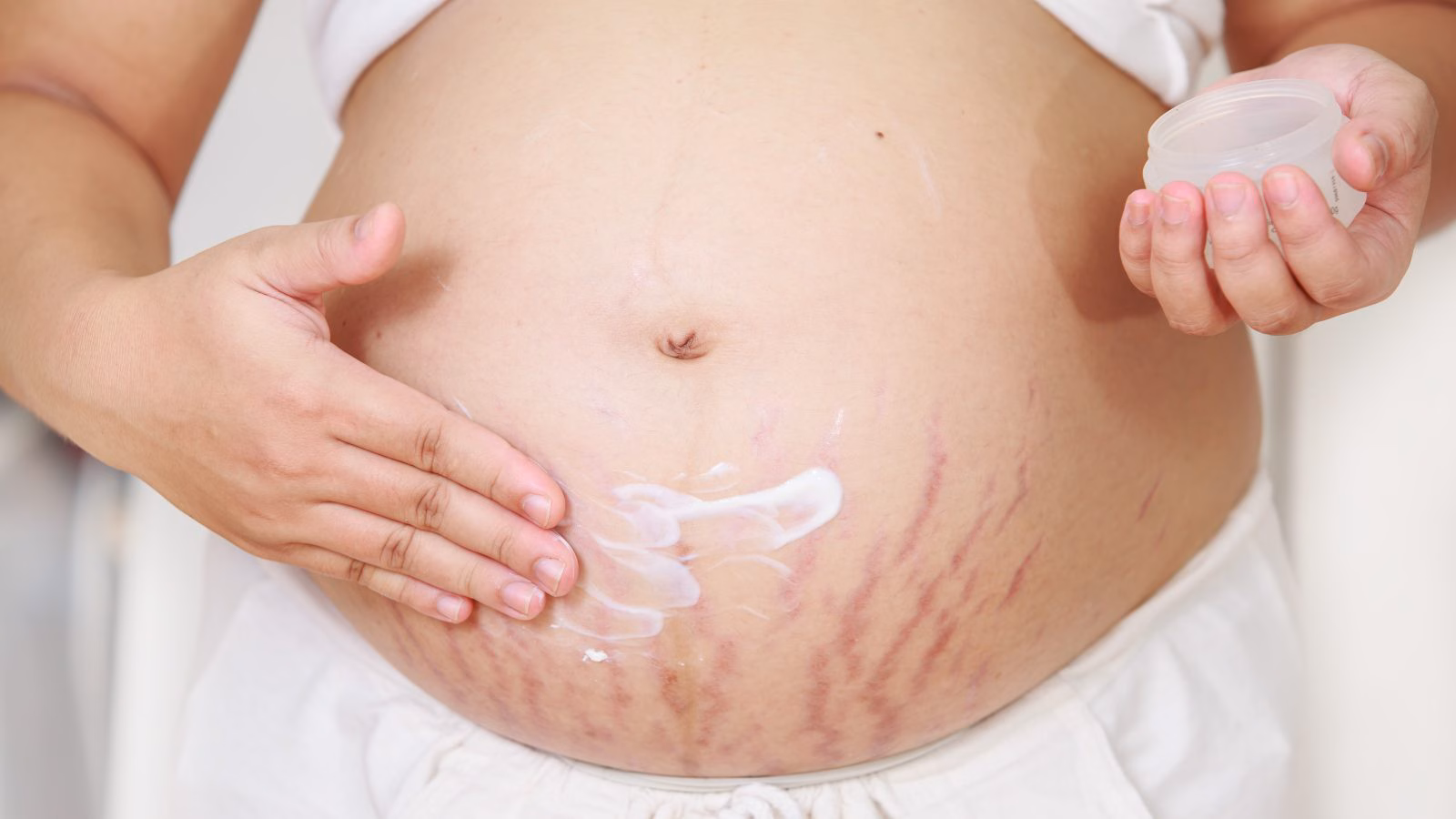 स्ट्रेच मार्क्स हटाने के आसान उपाय | Use these 7 tips and remove stretch marks 3 स्ट्रेच मार्क्स हटाने के आसान उपाय | Use these 7 tips and remove stretch marks